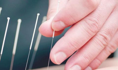 Hand with acupuncture needles