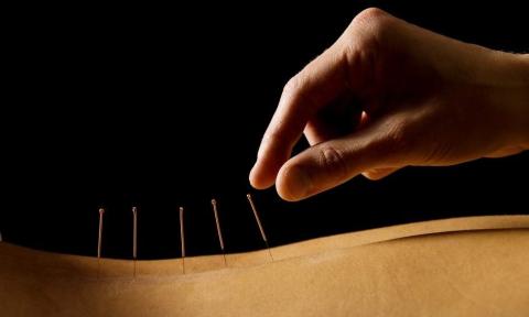 Acupuncture needles on a back with a hand placing them