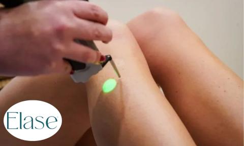 legs with laser removing hair, Elase logo in bottom left corner