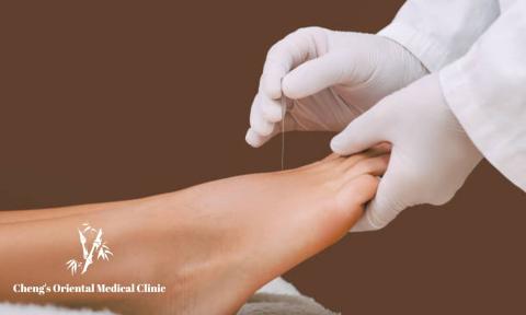 foot being held by hands with gloves inserting acupuncture needles with Cheng's Oriental Medical Clinic logo on bottom left corner