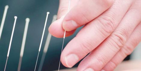 Hand with acupuncture needles