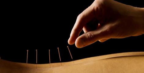 Acupuncture needles on a back with a hand placing them