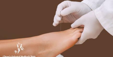 foot being held by hands with gloves inserting acupuncture needles with Cheng's Oriental Medical Clinic logo on bottom left corner
