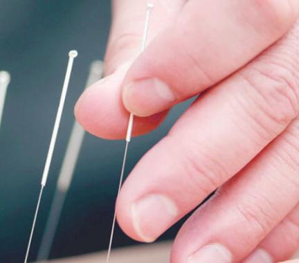 Hand with acupuncture needles